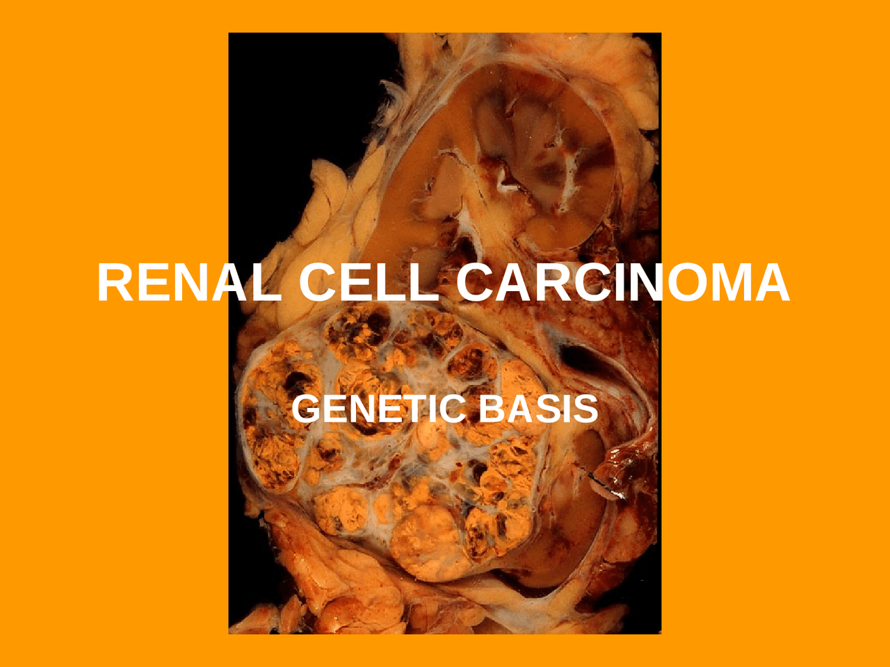 Carcinoma a cellule renali Docsity