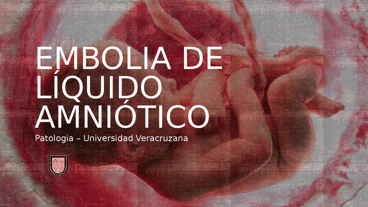 Embolia Por Liquido Amniótico - RETOEDU