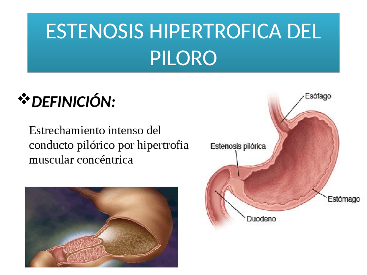 Estenosis hipertrofica | Diapositivas de Cirugía General | Docsity