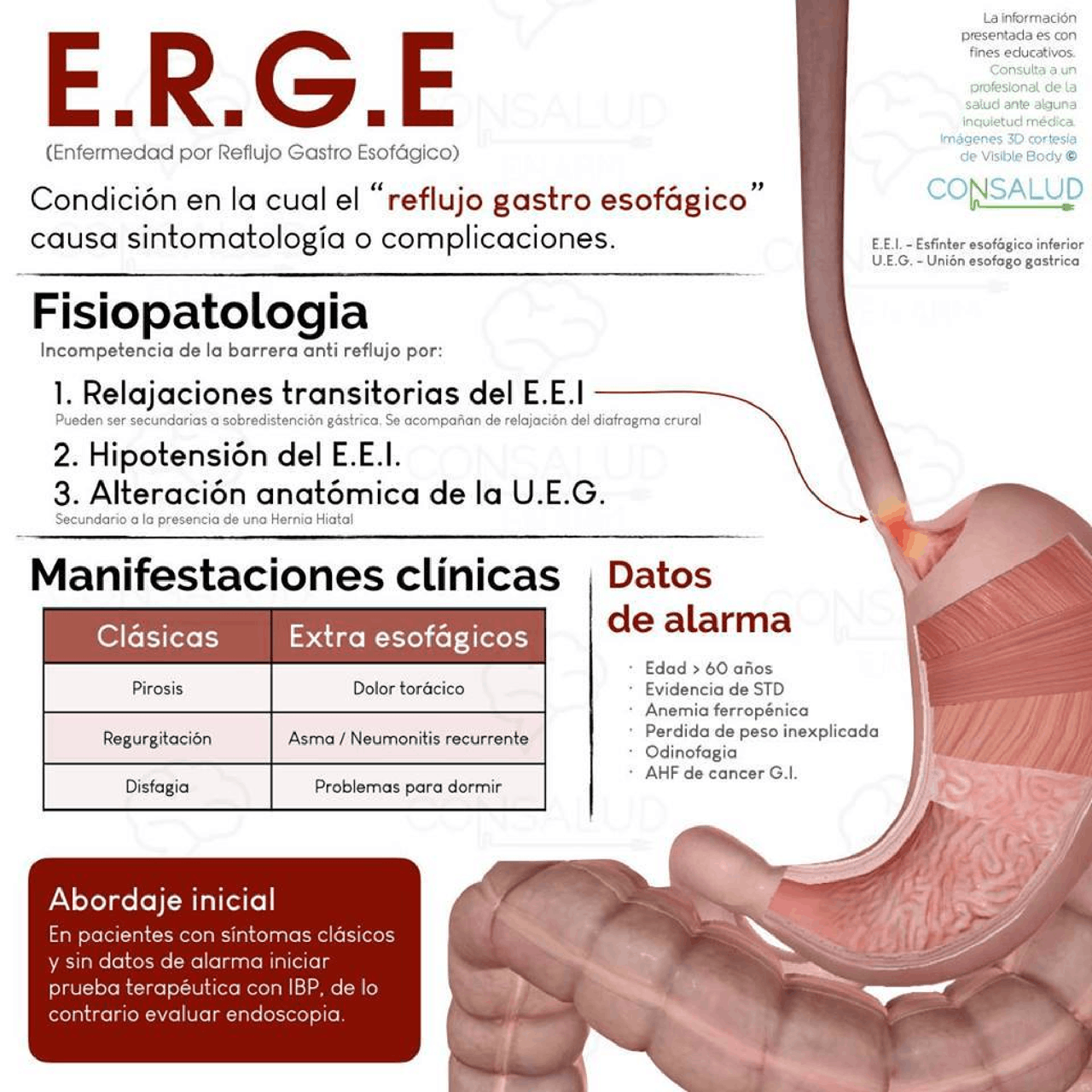 Enfermedad por reflujo gastroesofagico Esquemas y mapas conceptuales