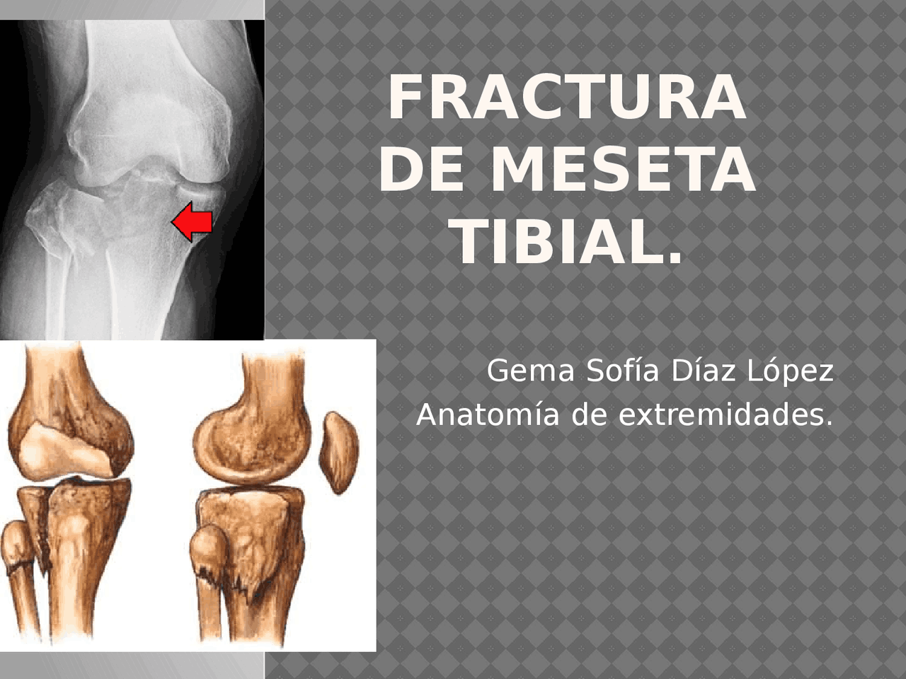Fractura De Meseta Tibial Diapositivas De Anatom a Docsity fractura-de-meseta-tibial-diapositivas-de-anatom-a-docsity