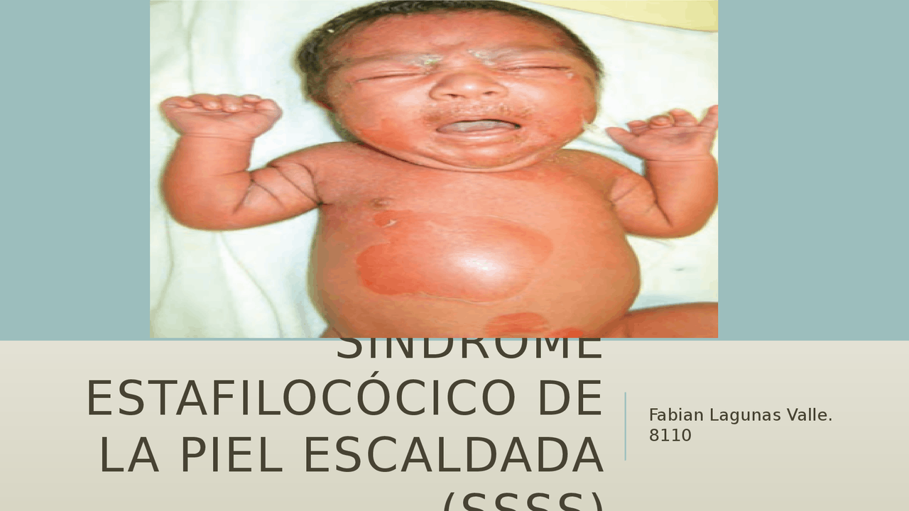 Síndrome estafilocócico de la piel escaldada | Diapositivas de