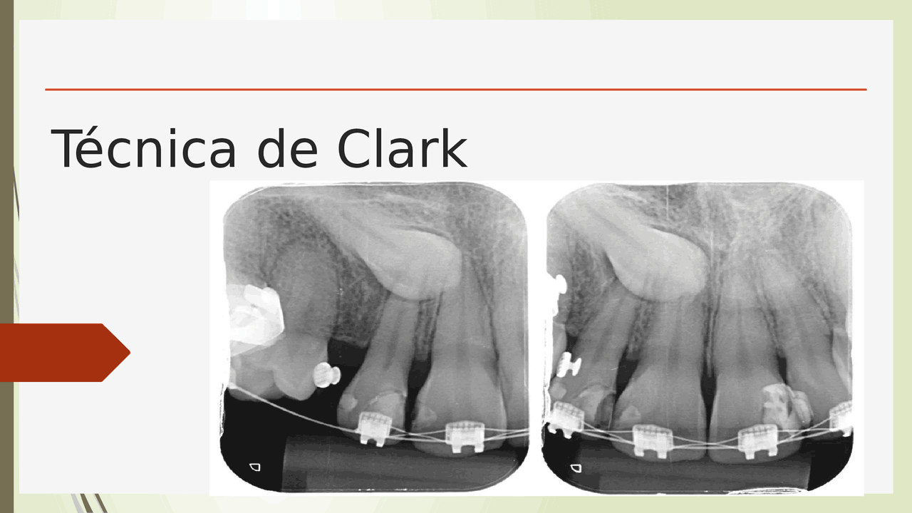 Clark Imaging Tecnica radiografica de clark | Slides Odontologia | Docsity