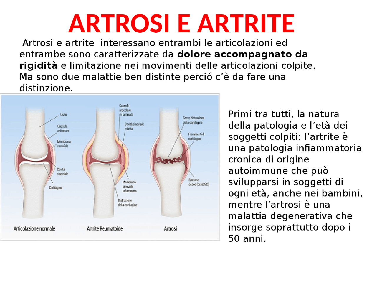 ARTROSI E ARTRITE APPUNTI Sintesi del corso di Anatomia Docsity ARTROSI E ARTRITE APPUNTI Sintesi del corso di Anatomia Docsity
