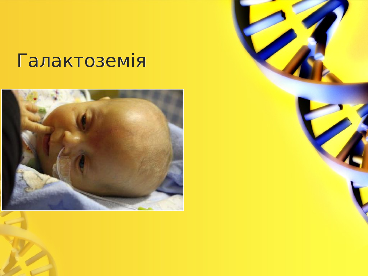 Презентація Галактоземія - Docsity
