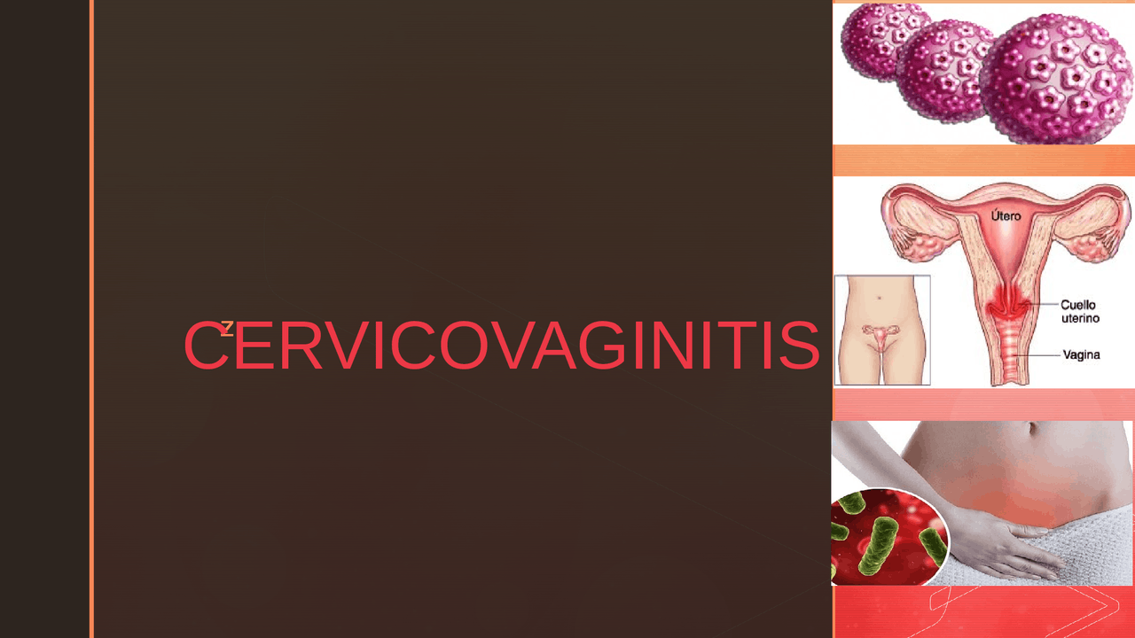 Cervicovaginitis en las mujeres - Docsity