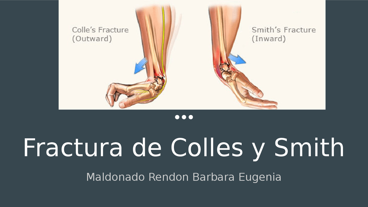Clasificaci n De Las Fracturas De Colles