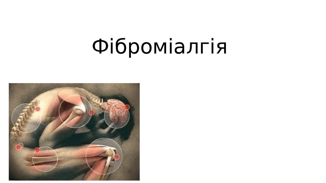 фіброміалгія презентація - Docsity