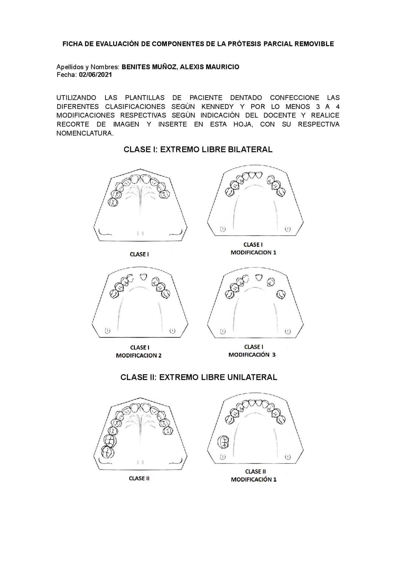 2 Clasificaci n De Kennedy Modificaciones PPR Apuntes De 2-clasificaci-n-de-kennedy-modificaciones-ppr-apuntes-de