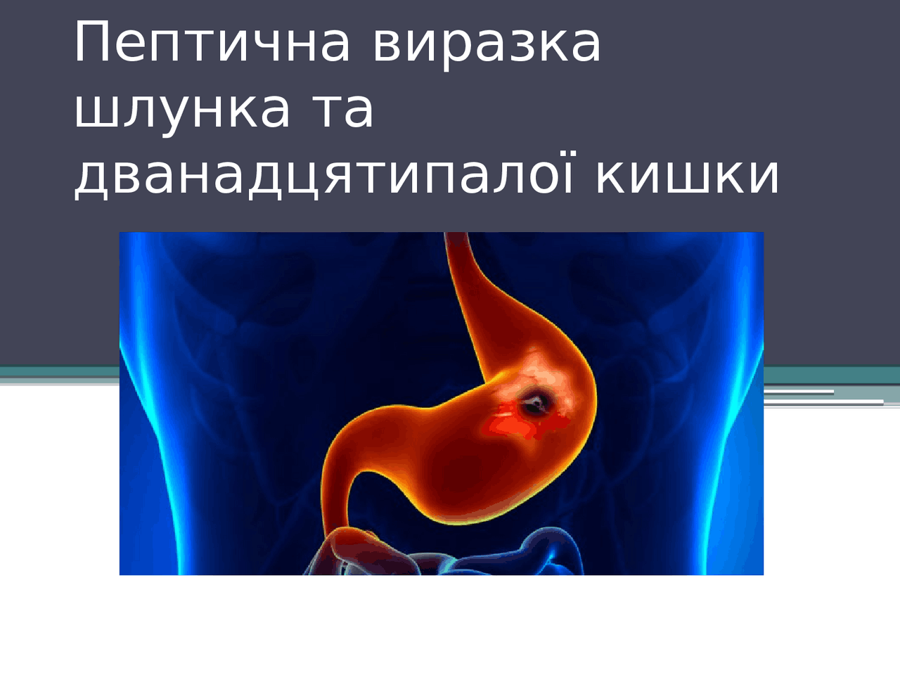 Пептична виразка шлунку і 12палої кишки - Docsity
