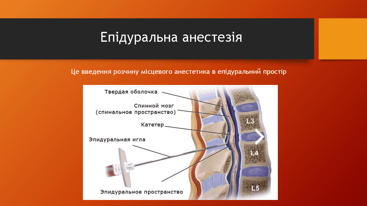 Епідуральна анестезія - Docsity