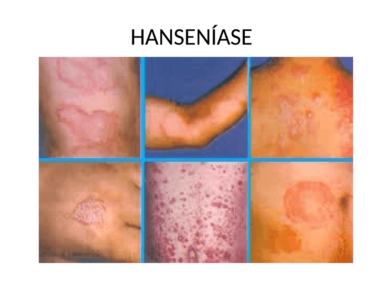 Slide sobre hanseniase e seus tipos - Docsity