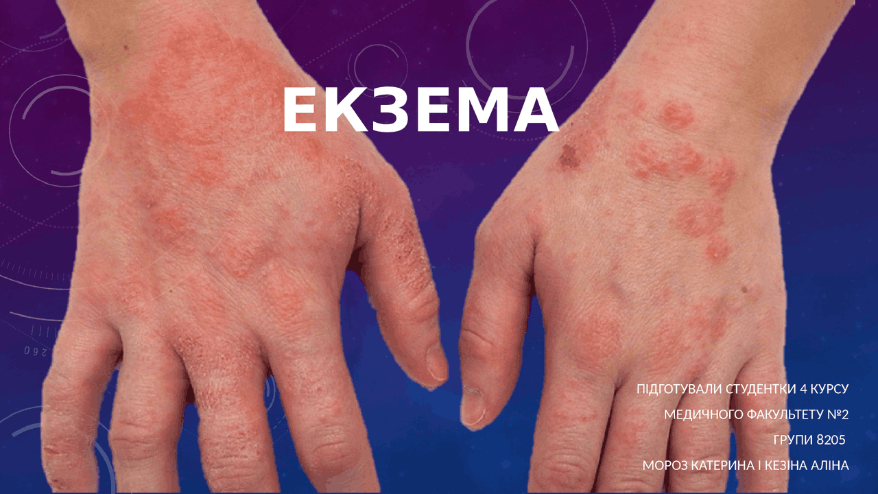 Презентация на тему Экземы , Екземи - Docsity