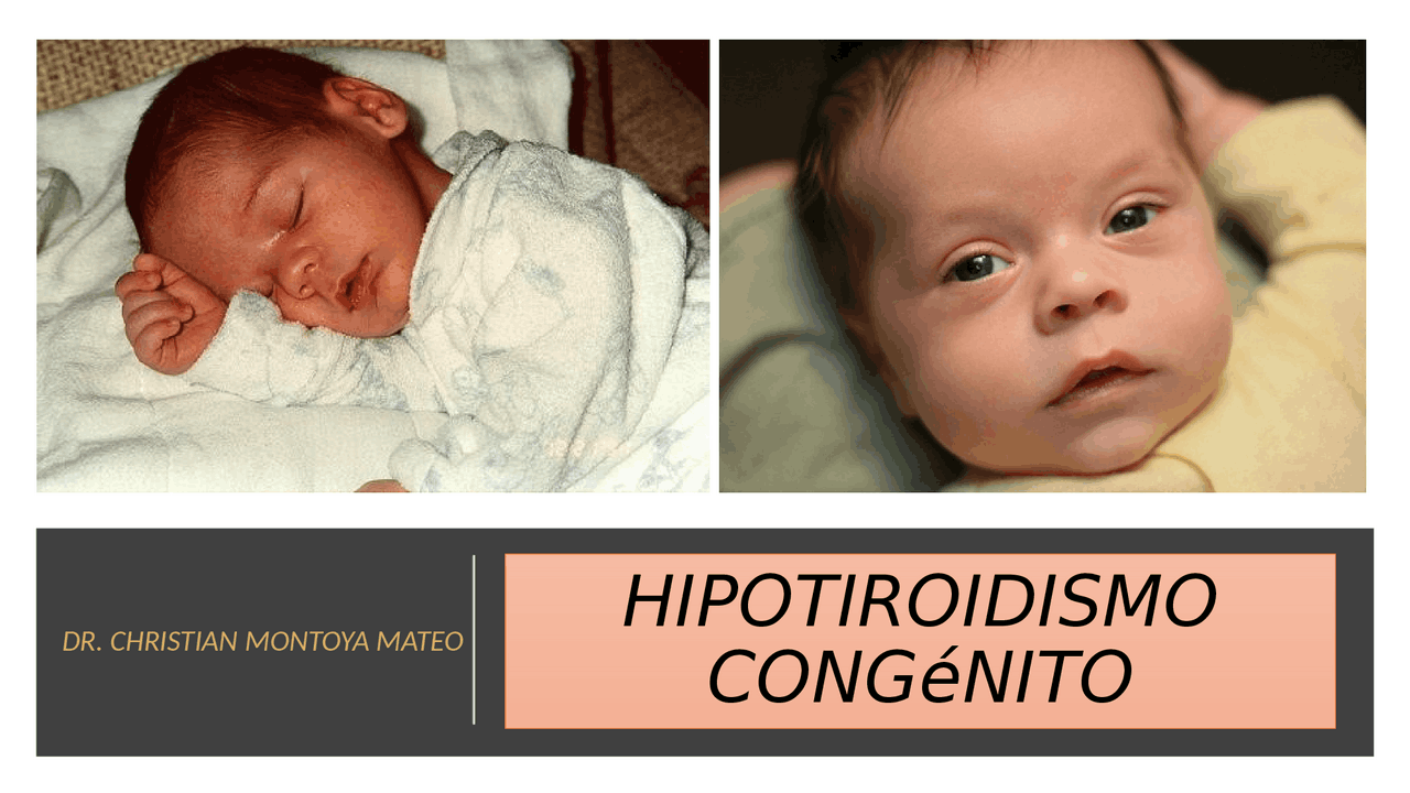 Imágenes De Bebés Con Hipotiroidismo Congénito