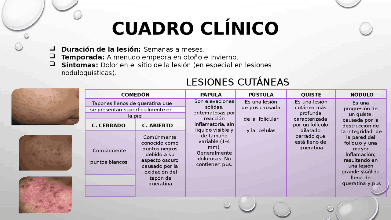 ACNÉ VULGAR (Definición, clasificación, descripción y tratamiento ...