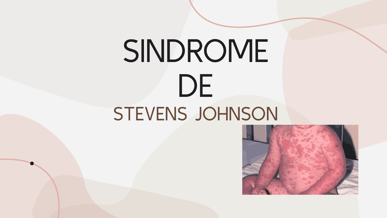 SINDROME DE STEVENS JOHNSON | Diapositivas de Medicina Interna | Docsity