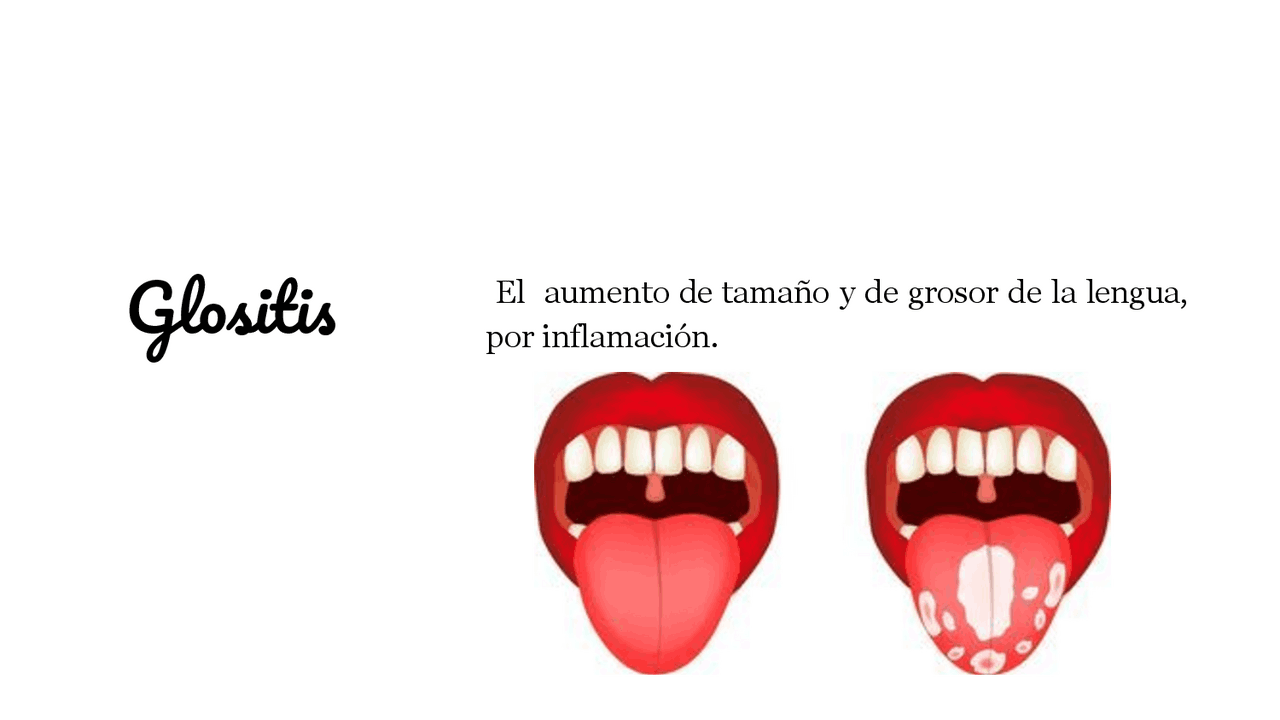 Glositis: Causas, Síntomas, Tratamientos Y Prevención – FUJWM