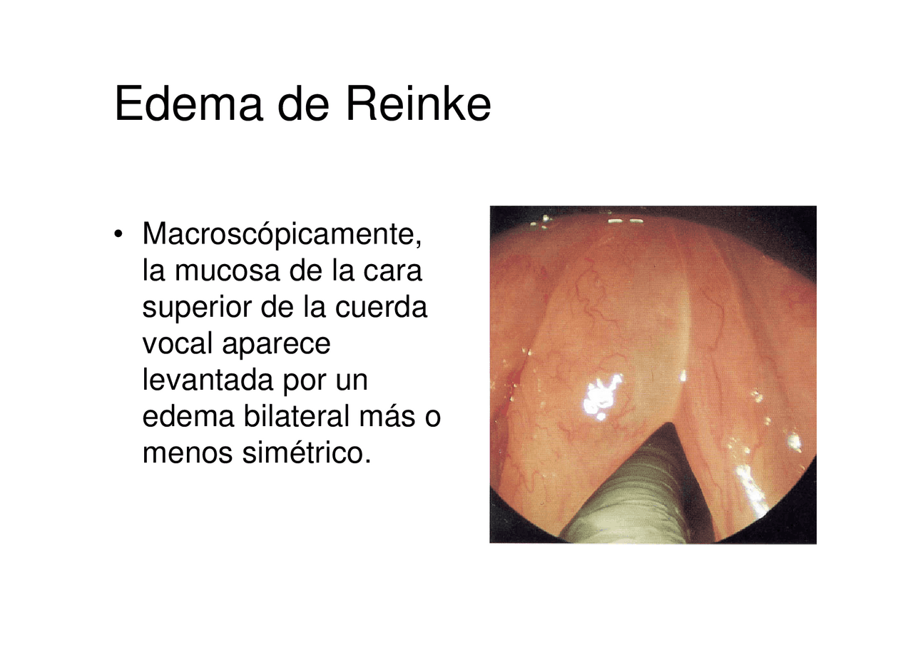 Edema de Reinke Resúmenes de Epidemiología Docsity