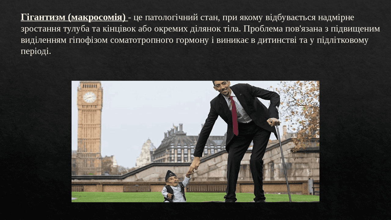 Презитація Гігантизм | Презентации Педиатрия | Docsity