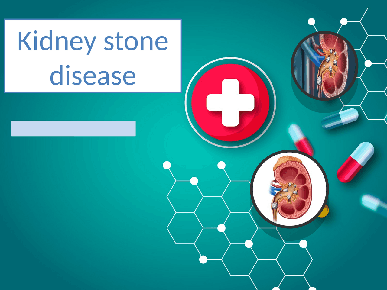 Презентація на тему Kidney stone disease Презентации Английский язык