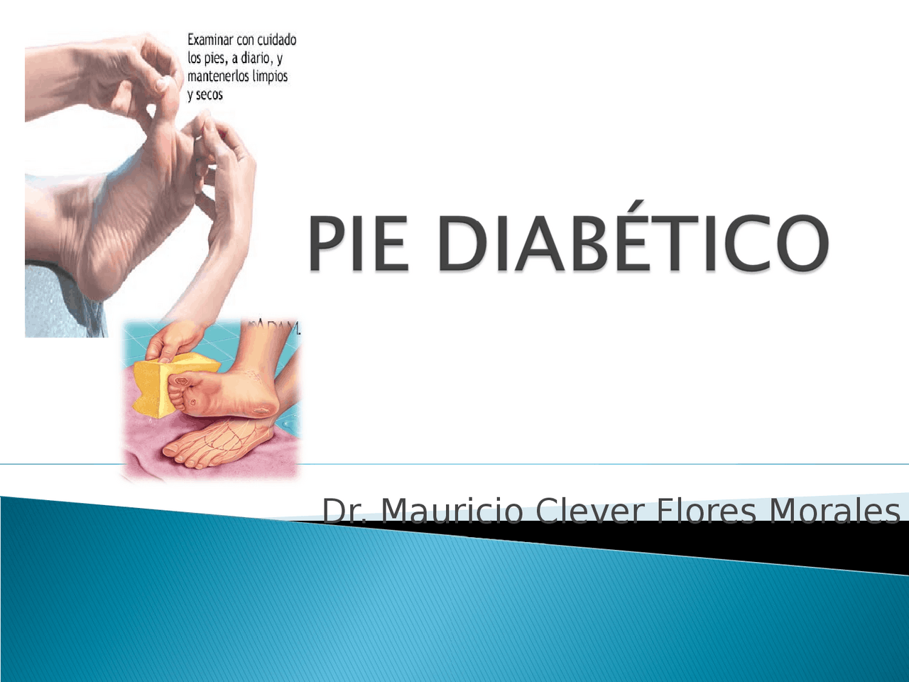 Pie diabetico y sus complicaciones y tratamientos Diapositivas de