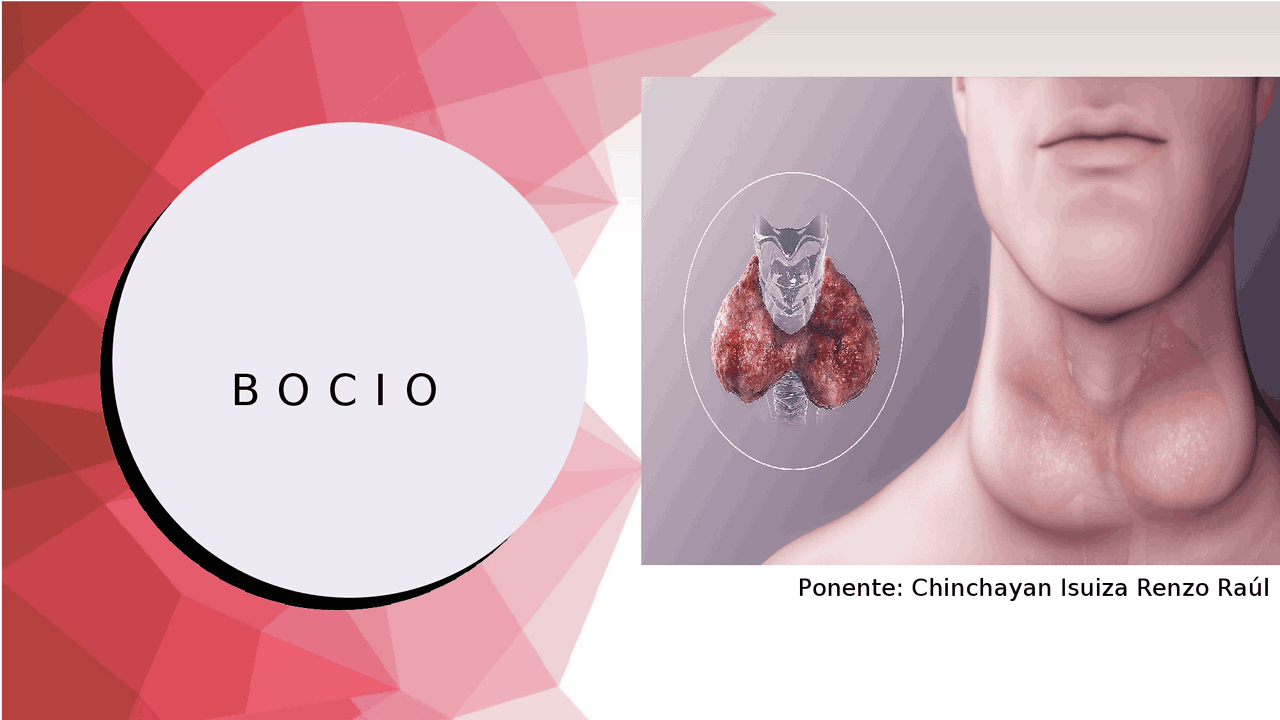 Bocio Epidemiología, Generalidades, Diagnóstico y Tratamiento