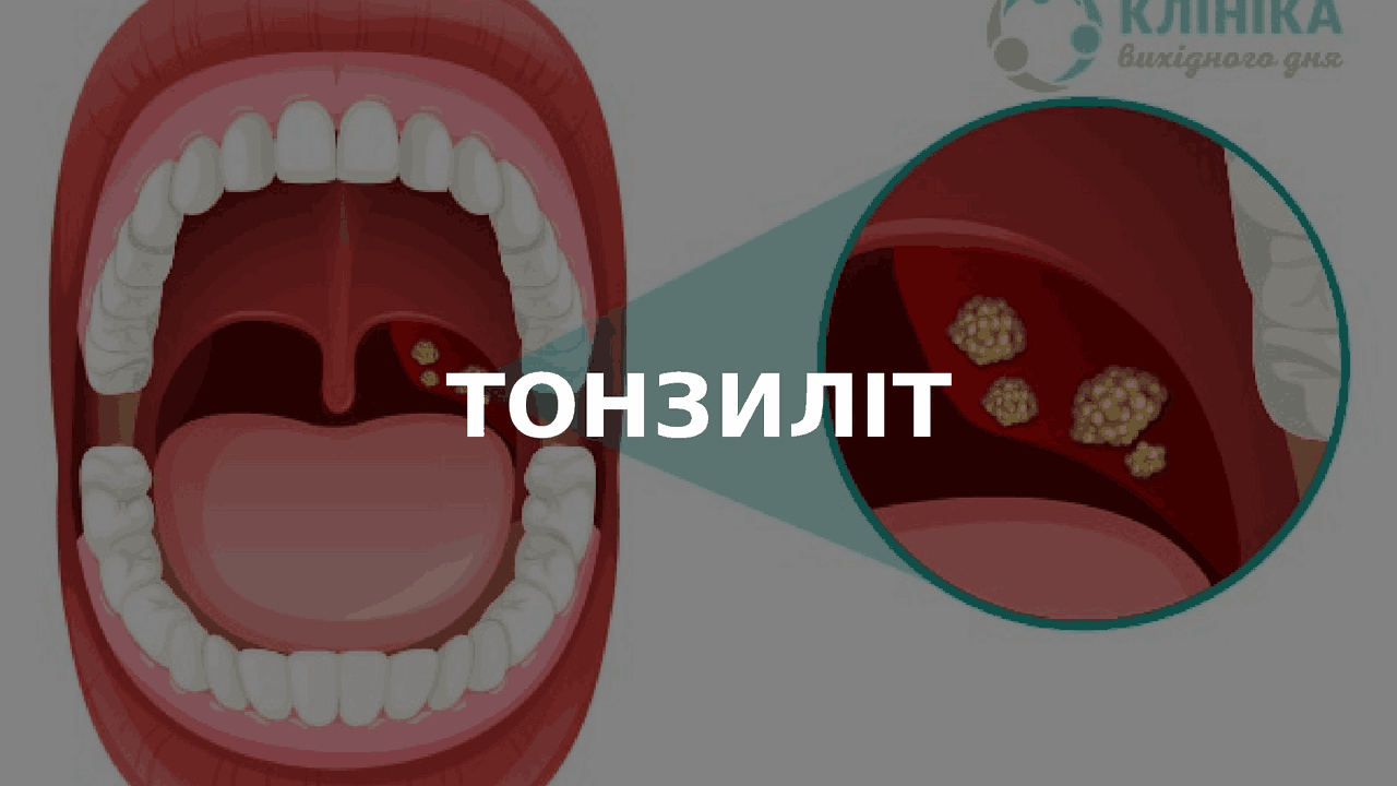Гострий та хронічний тонзиліт | Презентации Оториноларингология | Docsity