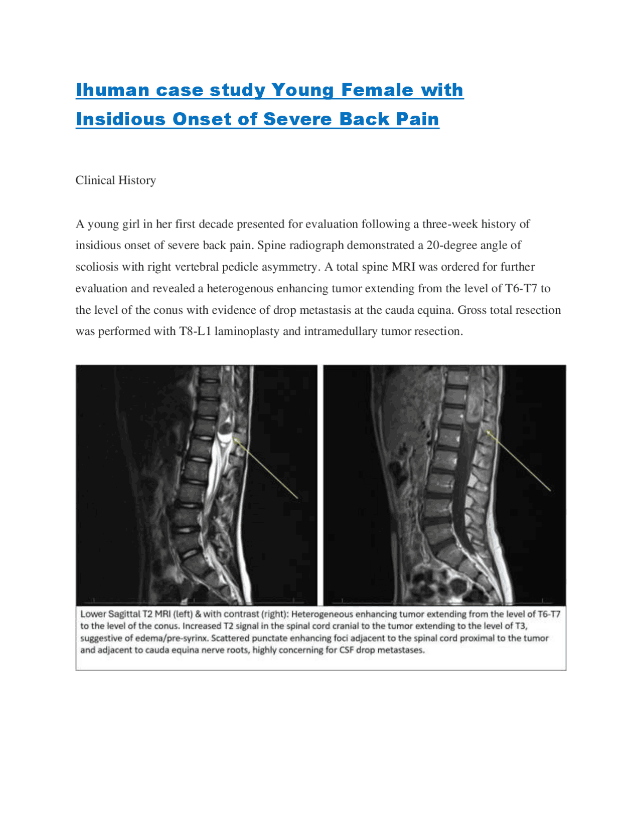 Ihuman case study Young Female with Insidious Onset of Severe Back Pain ...