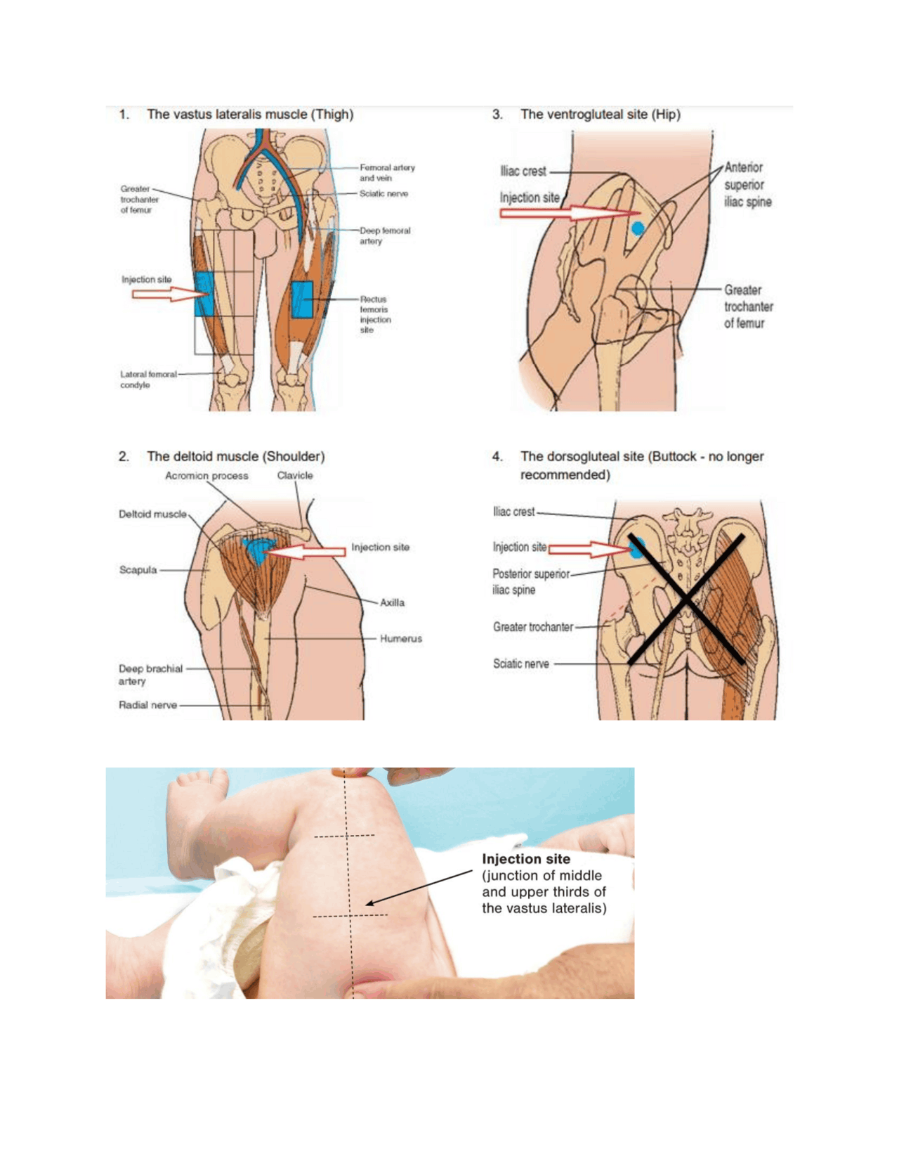 Dorsogluteal Muscle For Injection