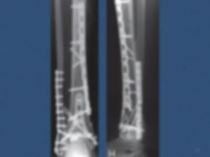 pf31