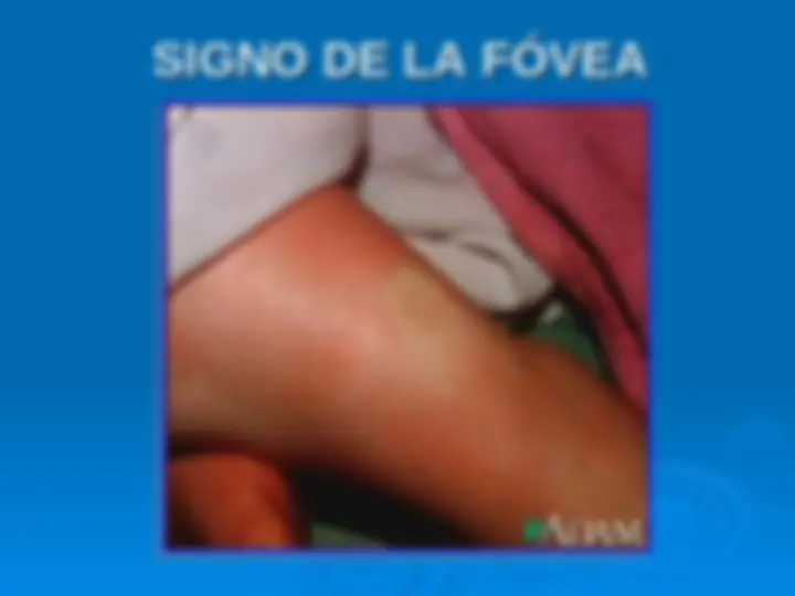 pf1d