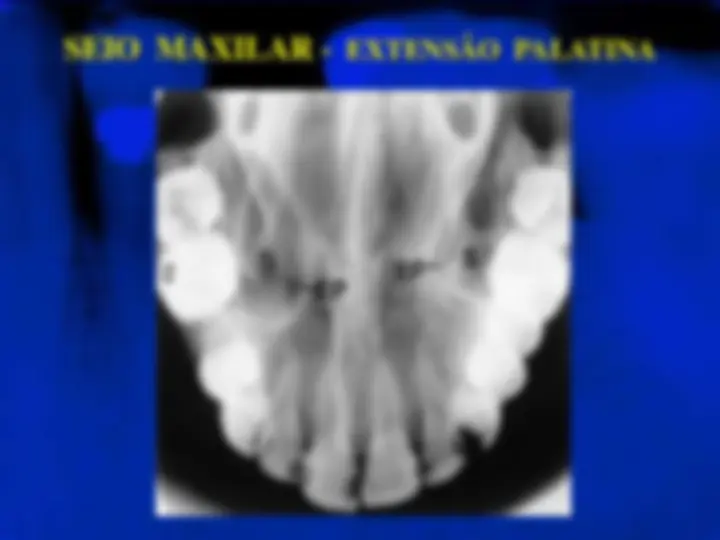 pf20