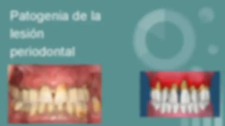 Static Caries Diagnostico de caries, lesiones pulpares y periodontales ...