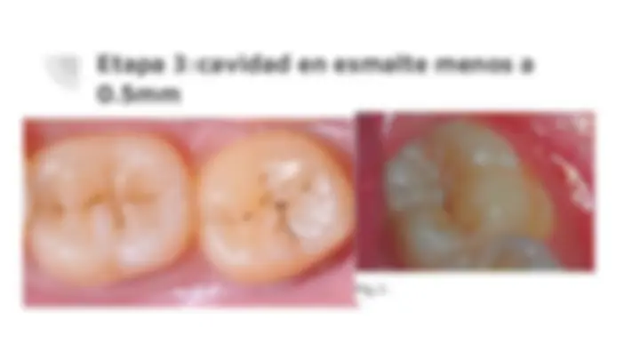 Static Caries Diagnostico de caries, lesiones pulpares y periodontales ...