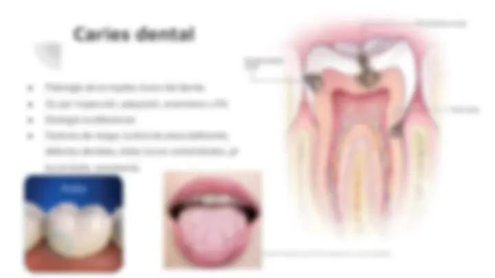 Static Caries Diagnostico de caries, lesiones pulpares y periodontales ...