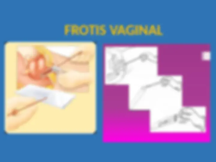 pf15