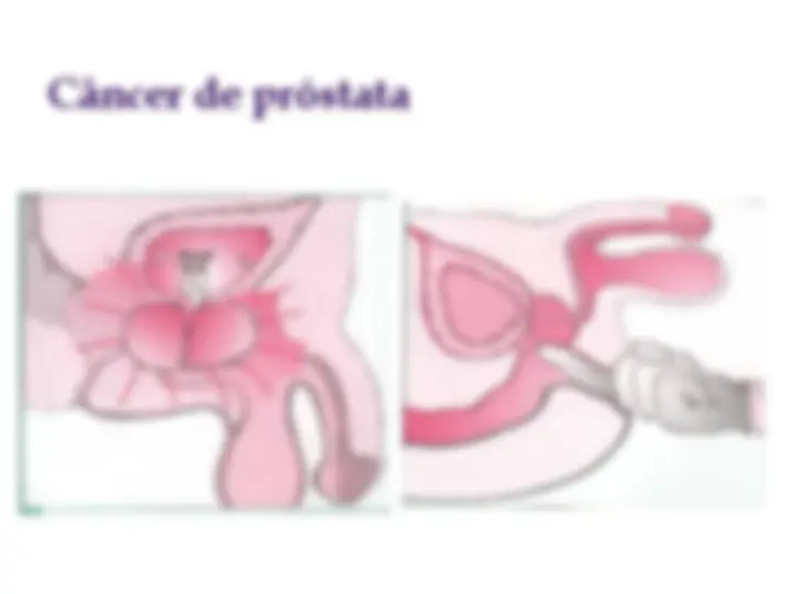 pf17