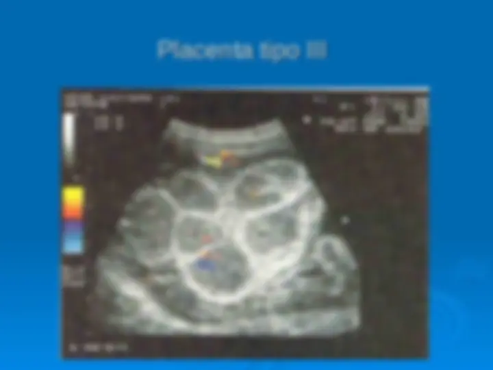 pf1f