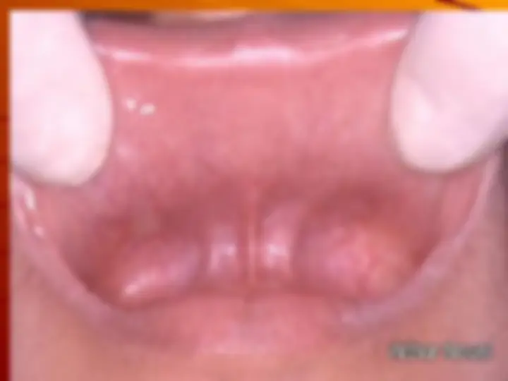 pfe