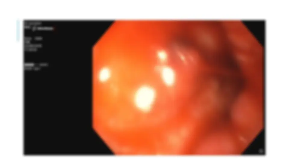pfe