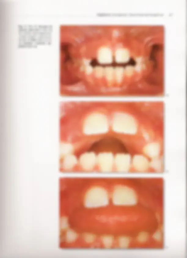 pf21