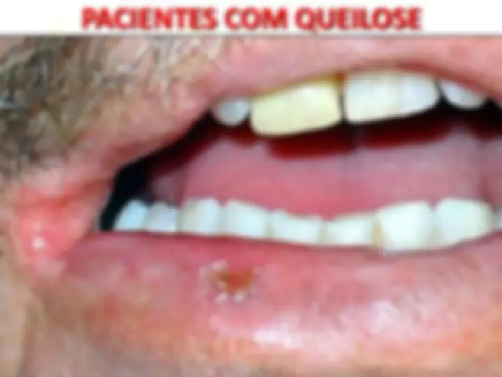 pf14