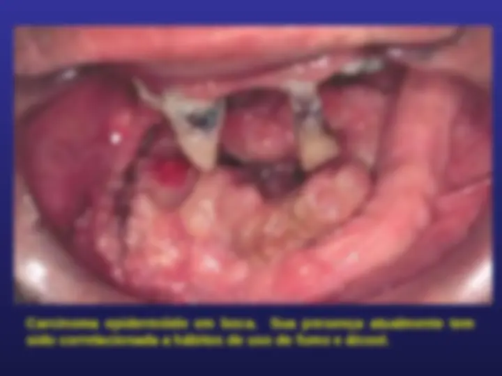 pf5