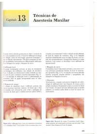 Anestesia - Capitulo 13 e 14 técnicas de anestesia maxilar e mandibular ...