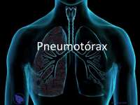 Pneumotórax - Apostilas - Pneumologia Parte1