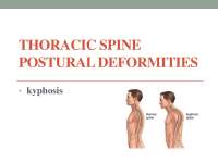 Posture deformity and correcting them