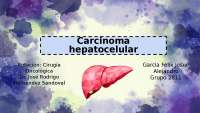 Carcinoma hepatocelular