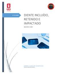 Diente Retenido, Incluido e Impactado