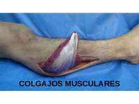 Colgajo muscular - Cirugía