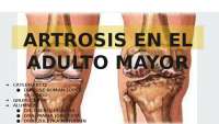 Fisiopatología y Manejo del Dolor en la Artrosis: Un Enfoque Integral